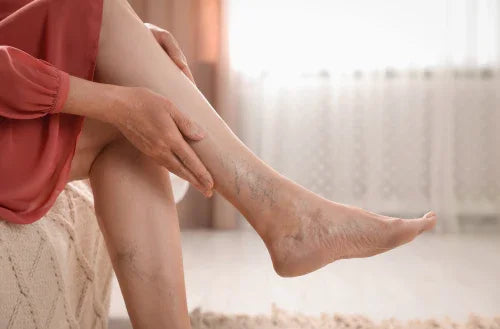 Manage the Symptoms of Varicose with Ayurveda
