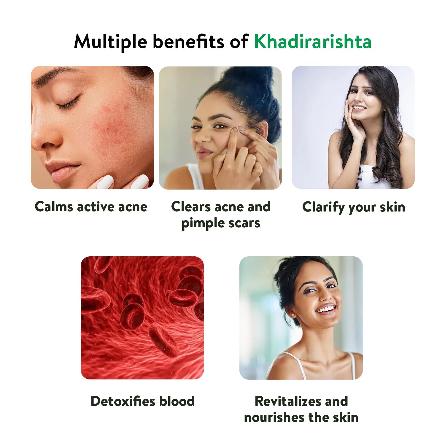 Banner titled "Multiple benefits of Khadirarishta," with visuals showing how Khadirarishta Arishtam calms active acne, clears acne and pimple scars, clarifies skin, detoxifies blood, and revitalizes and nourishes the skin. – Kerala Ayurveda India