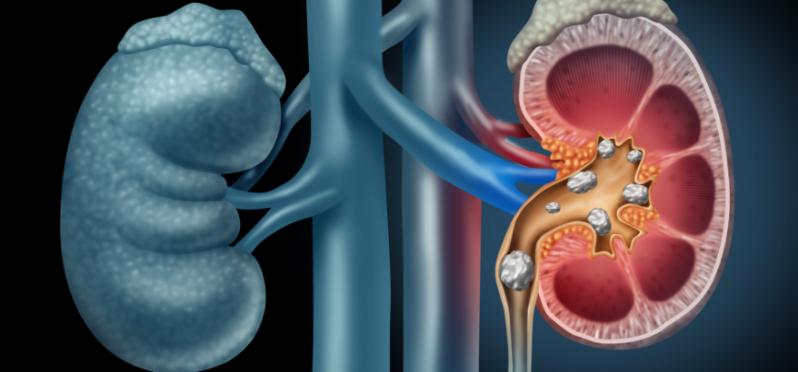 kidney stone & its types