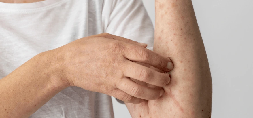 Know About Atopic Eczema