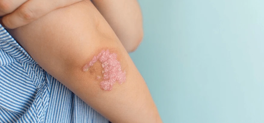 Symptoms of Venous Eczema