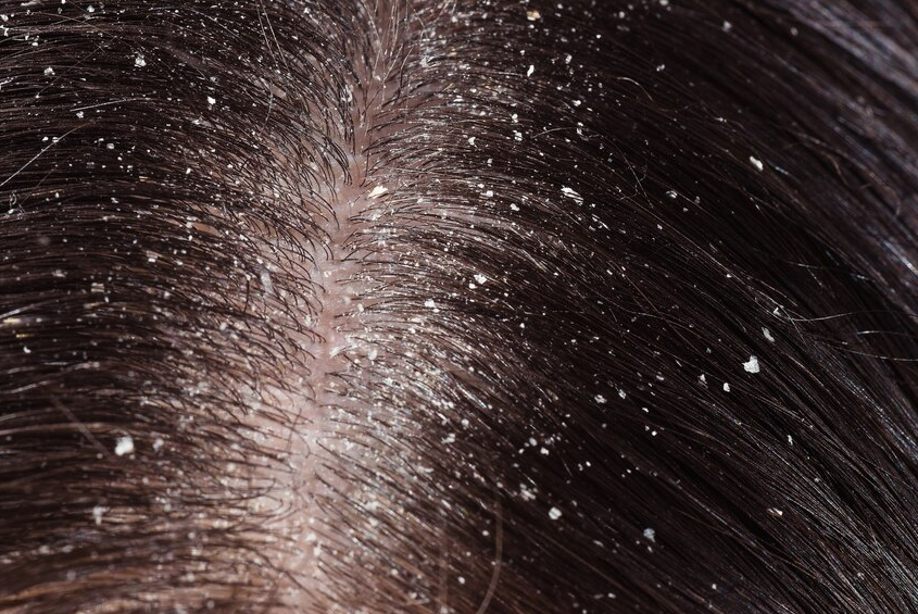 How to Get Rid of Dandruff & Itchy Scalp - The Ayurvedic Way